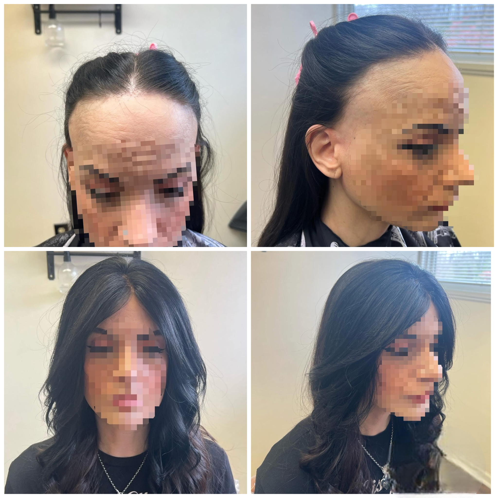 Hair Restoration